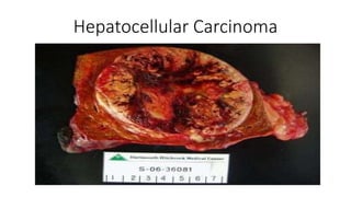 Hepatocellular Carcinoma
 