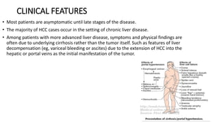 CLINICAL FEATURES
• Most patients are asymptomatic until late stages of the disease.
• The majority of HCC cases occur in the setting of chronic liver disease.
• Among patients with more advanced liver disease, symptoms and physical findings are
often due to underlying cirrhosis rather than the tumor itself. Such as features of liver
decompensation (eg, variceal bleeding or ascites) due to the extension of HCC into the
hepatic or portal veins as the initial manifestation of the tumor.
 