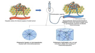 Chemotherapy agents used in TACE:
• Doxorubicin: Slows or stops the growth of cancer cells by blocking an
enzyme called topo isomerase 2 (which is needed for cancer cells to
divide and grow)
• Cisplatin: Binds to the N7 reactive center on purine residues and can
cause DNA damage in cancer cells, blocking cell division and resulting
in apoptotic cell death.
 