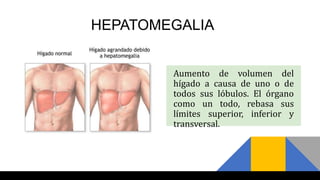 HEPATOMEGALIA
Aumento de volumen del
hígado a causa de uno o de
todos sus lóbulos. El órgano
como un todo, rebasa sus
límites superior, inferior y
transversal.
 