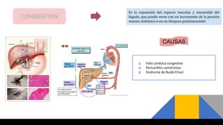 CONGESTIÓN
Es la expansión del espacio vascular y sinusoidal del
hígado, que puede verse con un incremento de la presión
venosa sistémica o en un bloqueo postsinusoidal.
CAUSAS
1) Falla cardíaca congestiva
2) Pericarditis constrictiva
3) Síndrome de Budd-Chiari
 