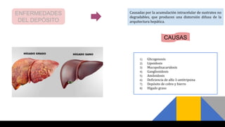 ENFERMEDADES
DEL DEPÓSITO
Causadas por la acumulación intracelular de sustratos no
degradables, que producen una distorsión difusa de la
arquitectura hepática.
CAUSAS
1) Glicogenosis
2) Lipoidosis
3) Mucopolisacaridosis
4) Gangliosidosis
5) Amiloidosis
6) Deficiencia de alfa-1-antitripsina
7) Depósito de cobre y hierro
8) Hígado graso
 