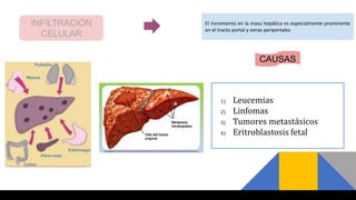INFILTRACIÓN
CELULAR
El incremento en la masa hepática es especialmente prominente
en el tracto portal y zonas periportales
CAUSAS
1) Leucemias
2) Linfomas
3) Tumores metastásicos
4) Eritroblastosis fetal
 