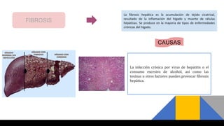 FIBROSIS
La fibrosis hepática es la acumulación de tejido cicatrizal,
resultado de la inflamación del hígado y muerte de células
hepáticas. Se produce en la mayoría de tipos de enfermedades
crónicas del hígado.
CAUSAS
La infección crónica por virus de hepatitis o el
consumo excesivo de alcohol, así como las
toxinas u otros factores pueden provocar fibrosis
hepática.
 
