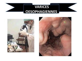 VARICES
OESOPHAGIENNES
 