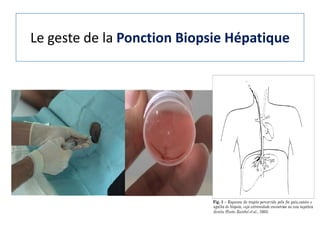 Le geste de la Ponction Biopsie Hépatique
 