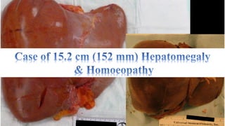 Hepatomegaly (15.2 cm, 152 mm liver enlargement) & Homoeopathy