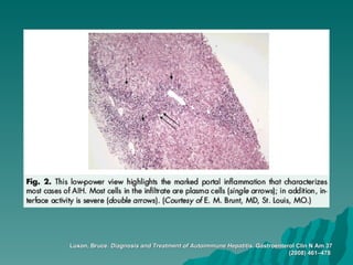 Luxon, Bruce.  Diagnosis and Treatment of Autoimmune Hepatitis.  Gastroenterol Clin N Am 37 (2008) 461–478   