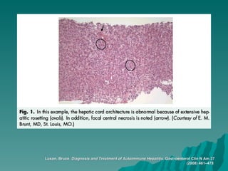 Luxon, Bruce.  Diagnosis and Treatment of Autoimmune Hepatitis.  Gastroenterol Clin N Am 37 (2008) 461–478   
