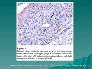 Teru Kumagi and E. Jenny Heathcote.  Primary Biliary Cirrhosis.   Orphanet Journal of Rare Diseases  2008, 3:1 