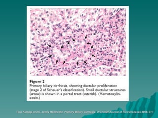 Teru Kumagi and E. Jenny Heathcote.  Primary Biliary Cirrhosis.   Orphanet Journal of Rare Diseases  2008, 3:1 