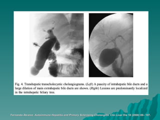 Fernando Álvarez.  Autoimmune Hepatitis and Primary Sclerosing Cholangitis.  Clin Liver Dis 10 (2006) 89– 107.   