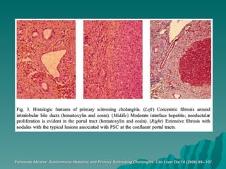 Fernando Álvarez.  Autoimmune Hepatitis and Primary Sclerosing Cholangitis.  Clin Liver Dis 10 (2006) 89– 107.   