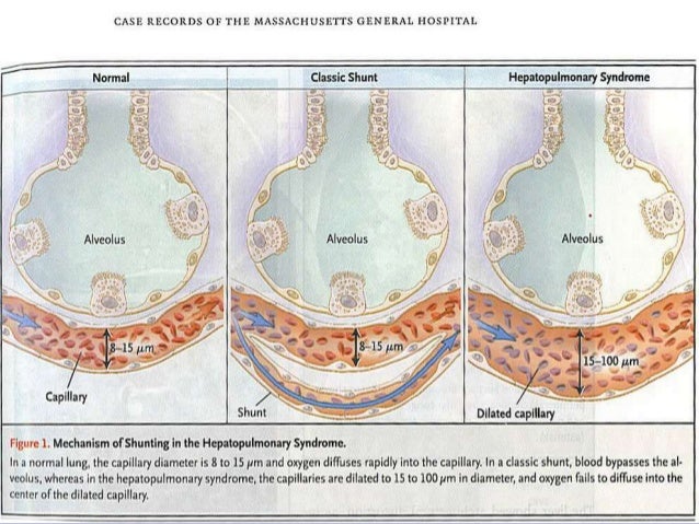 portal hypertension
