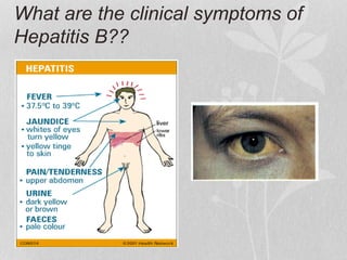 What are the clinical symptoms of
Hepatitis B??
 