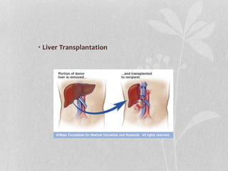 • Liver Transplantation
 