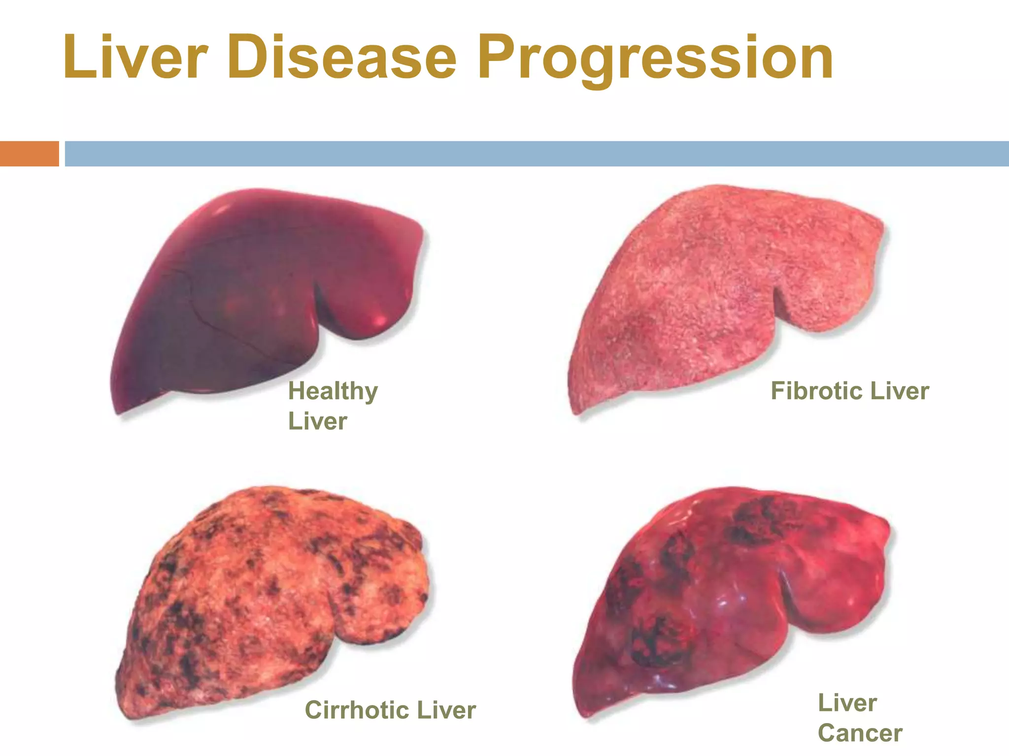 Liver Disease Progression




       Healthy            Fibrotic Liver
       Liver




        Cirrhotic Liver       Liver
                              Cancer
 