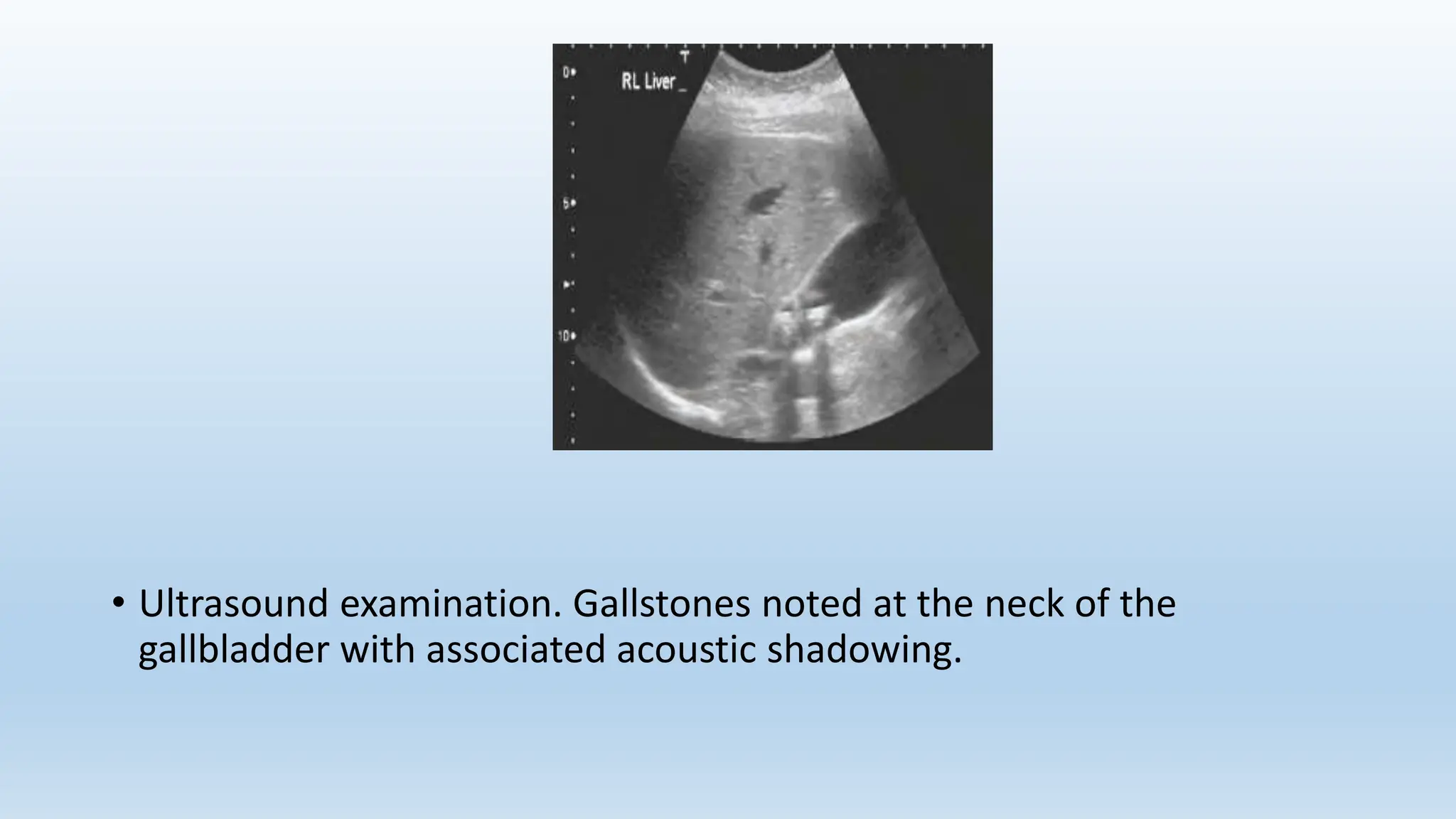 Hepato Biliary.pptx