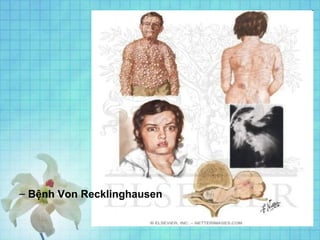 – Bệnh Von Recklinghausen
 