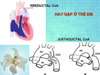 PREDUCTAL CoA
HAY GẶP Ở TRẺ EMHAY GẶP Ở TRẺ EM
JUXTADUCTAL CoA
 