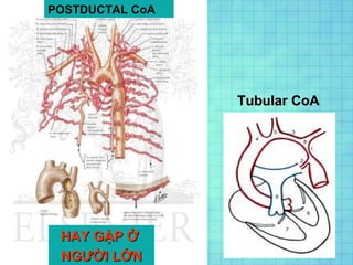 POSTDUCTAL CoA
HAY GẶP ỞHAY GẶP Ở
NGƯỜI LỚNNGƯỜI LỚN
Tubular CoATubular CoA
 