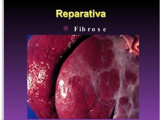 Fibrose 