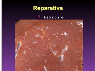 Fibrose 