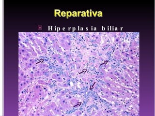 Hiperplasia biliar 