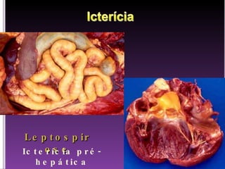 Leptospirose Icterícia pré-hepática 