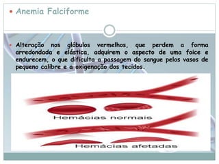  Anemia Falciforme 
 Alteração nos glóbulos vermelhos, que perdem a forma 
arredondada e elástica, adquirem o aspecto de uma foice e 
endurecem, o que dificulta a passagem do sangue pelos vasos de 
pequeno calibre e a oxigenação dos tecidos. 
 