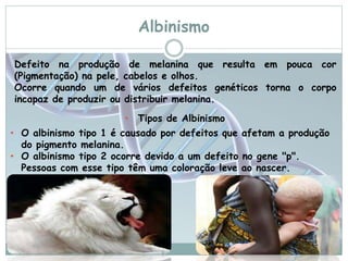Albinismo 
Defeito na produção de melanina que resulta em pouca cor 
(Pigmentação) na pele, cabelos e olhos. 
Ocorre quando um de vários defeitos genéticos torna o corpo 
incapaz de produzir ou distribuir melanina. 
• Tipos de Albinismo 
• O albinismo tipo 1 é causado por defeitos que afetam a produção 
do pigmento melanina. 
• O albinismo tipo 2 ocorre devido a um defeito no gene "p". 
Pessoas com esse tipo têm uma coloração leve ao nascer. 
 