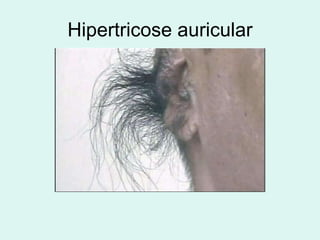 Hipertricose auricular 