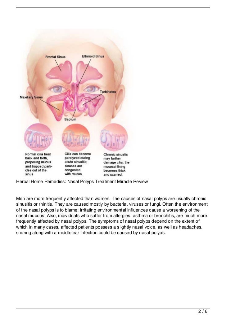 How To Cure Nasal Polyps At Home Naturally How To Cure Nasal Polyps At Home Naturally