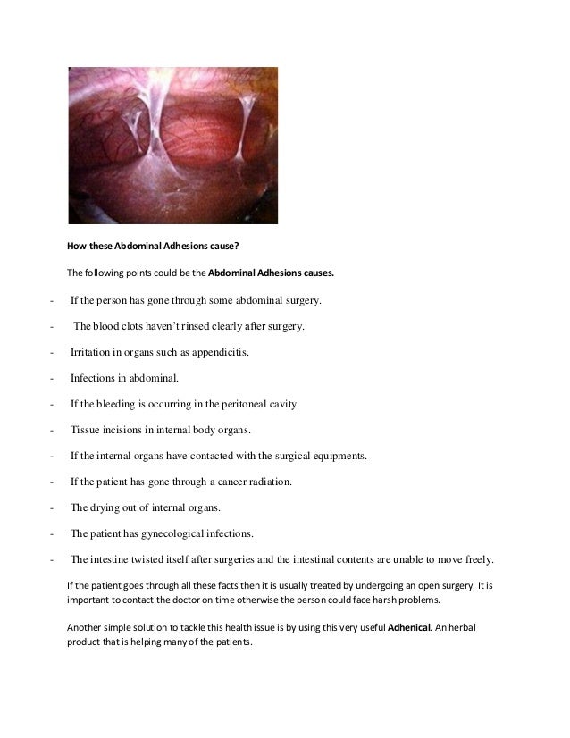 Abdominal Adhesions Treatment, Symptoms, Causes, Remedy