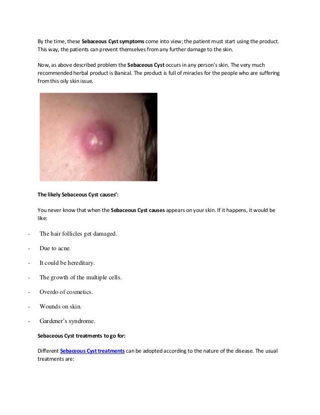 Sebaceous Cyst Treatment, Symptoms, Remedy, Causes