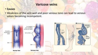 Varicose veins
• Causes
• Weakness of the vein wall and poor venous tone can lead to venous
valves becoming incompetent.
 