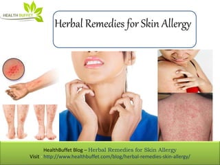 HealthBuffet Blog – Herbal Remedies for Skin Allergy
Visit - http://www.healthbuffet.com/blog/herbal-remedies-skin-allergy/
Herbal Remedies for Skin Allergy
 