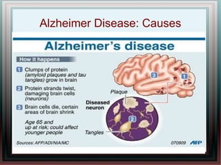 Alzheimer Disease: Causes
 