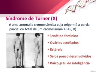 Síndrome de Turner (X) 
é uma anomalia cromossômica cuja origem é a perda 
parcial ou total de um cromossoma X (45, X) 
• Fenótipo feminino 
• Ovários atrofiados 
• Estéreis 
• Seios pouco desenvolvidos 
• Baixo grau de inteligência 
 