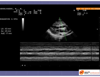 LA : 43 mm
Ao : 25 mm
AoE: 17 mm
 