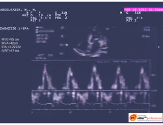 MVE=95 cm
MVA=42cm
E/A =2.22222
IVRT=87 ms
 