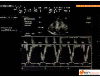Vmax=1 m/s
maxSPG=4 mmHg
 