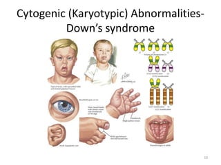 Cytogenic (Karyotypic) Abnormalities-
Down’s syndrome
10
 