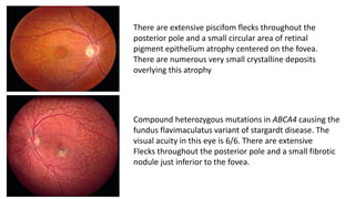 Hereditary Macular Dystrophies PPTX hereditary-macular-dystrophies-pptx