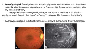 Hereditary macular dystrophies | PPTX