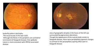Hereditary macular dystrophies | PPTX
