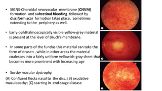 Disciform Macula Hereditary macular dystrophies | PPTX