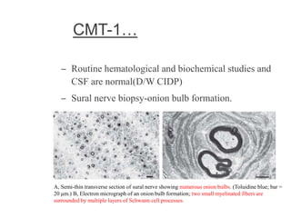CMT-1…
– Routine hematological and biochemical studies and
CSF are normal(D/W CIDP)
– Sural nerve biopsy-onion bulb formation.
A, Semi-thin transverse section of sural nerve showing numerous onion bulbs. (Toluidine blue; bar =
20 μm.) B, Electron micrograph of an onion bulb formation; two small myelinated fibers are
surrounded by multiple layers of Schwann cell processes.
 