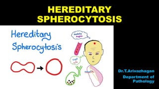 HEREDITARY
SPHEROCYTOSIS
Dr.T.Arivazhagan
Department of
Pathology
 