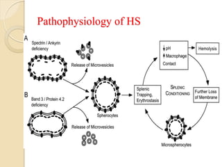 Hereditary spherocytosis asif new | PDF